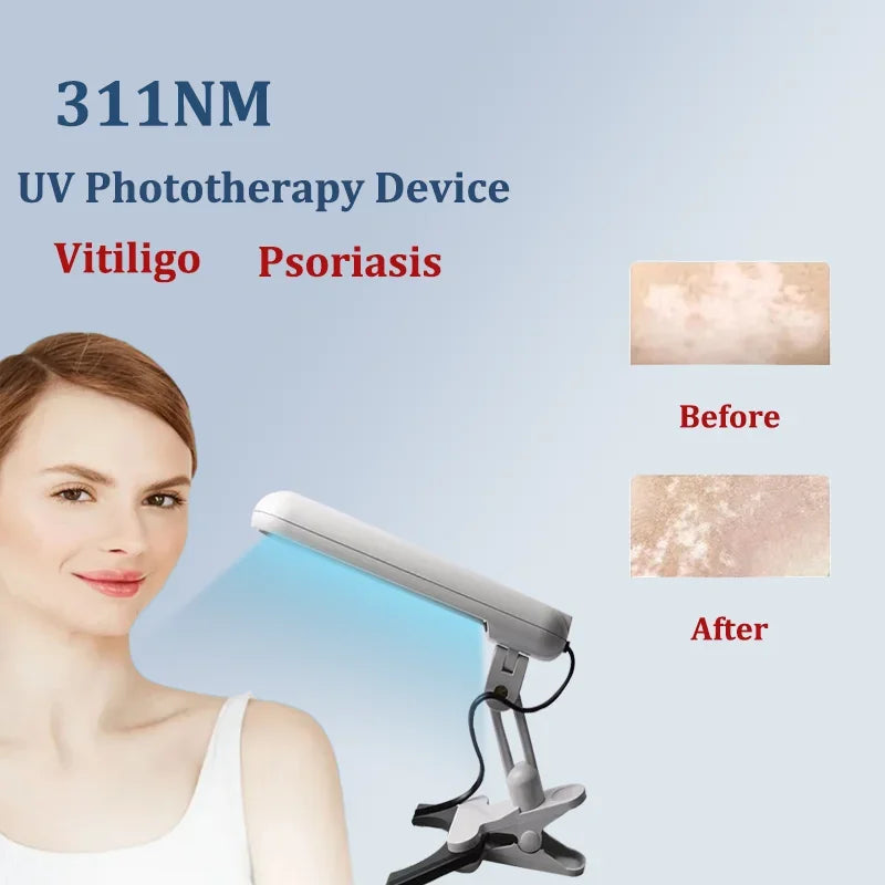 311nm UVB Lamp Phototherapy Instrument for Skin Diseases Vitiligo Psoriasis White Spots Treatment Ultraviolet Therapy Device