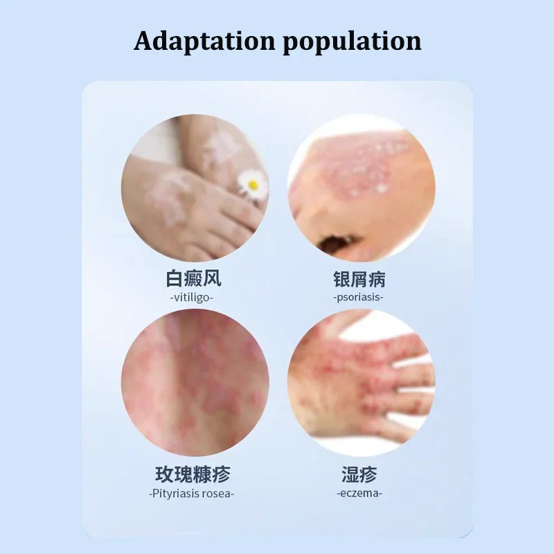 311nm UVB Lamp Phototherapy Instrument for Skin Diseases Vitiligo Psoriasis White Spots Treatment Ultraviolet Therapy Device