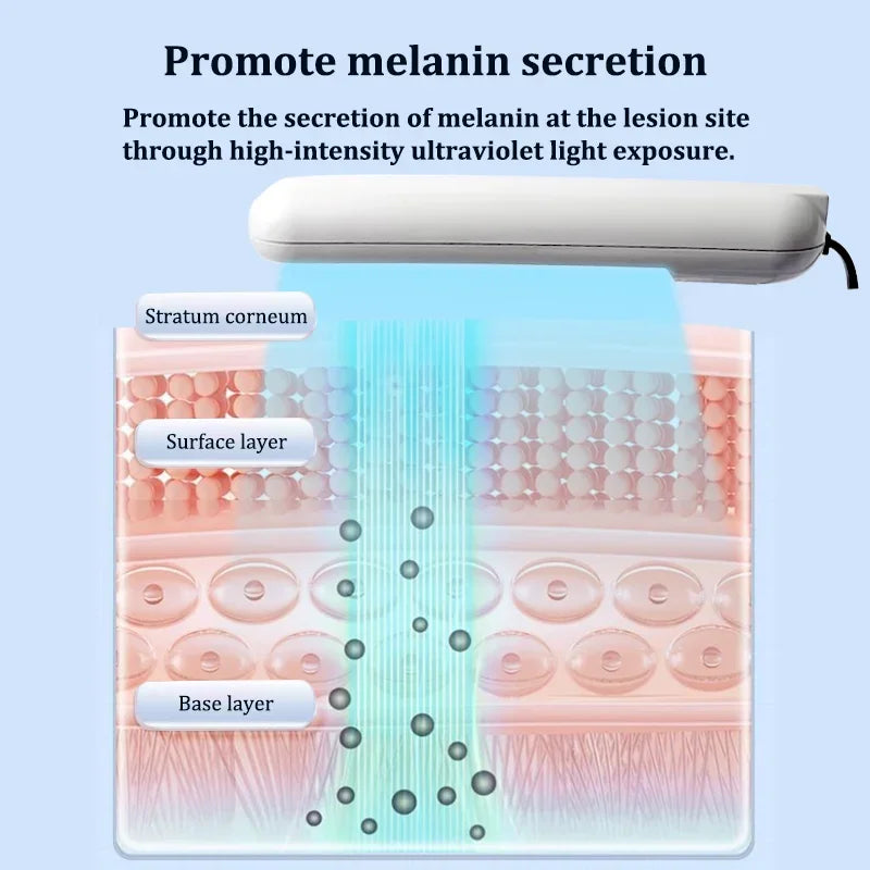 311nm UVB Lamp Phototherapy Instrument for Skin Diseases Vitiligo Psoriasis White Spots Treatment Ultraviolet Therapy Device